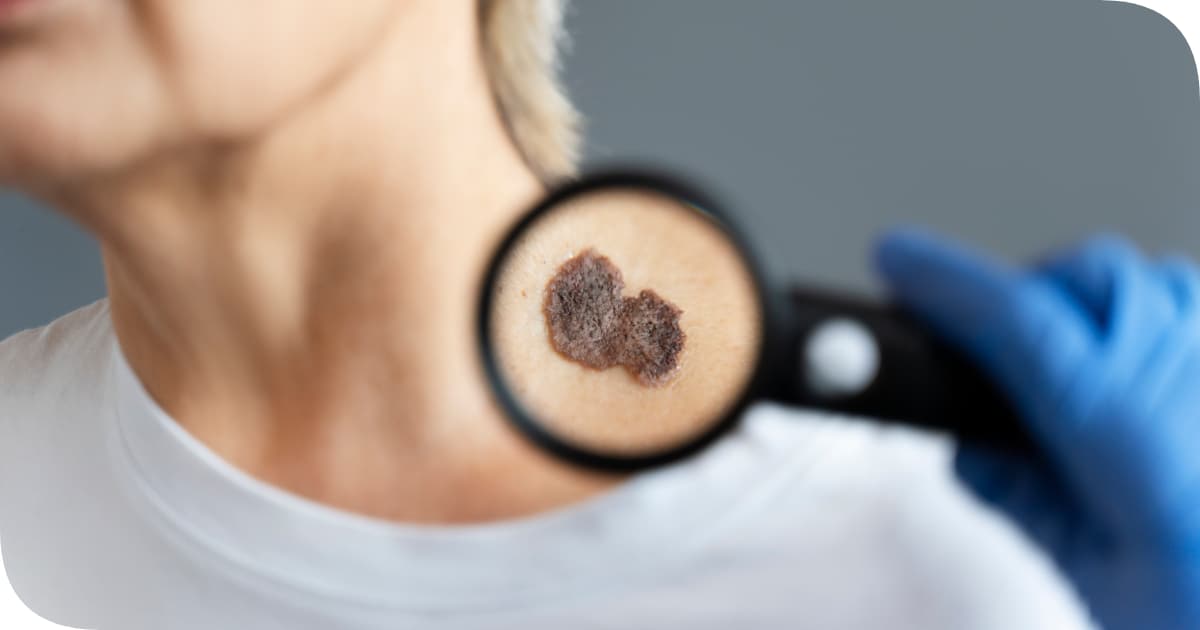 badanie znamion Kraków