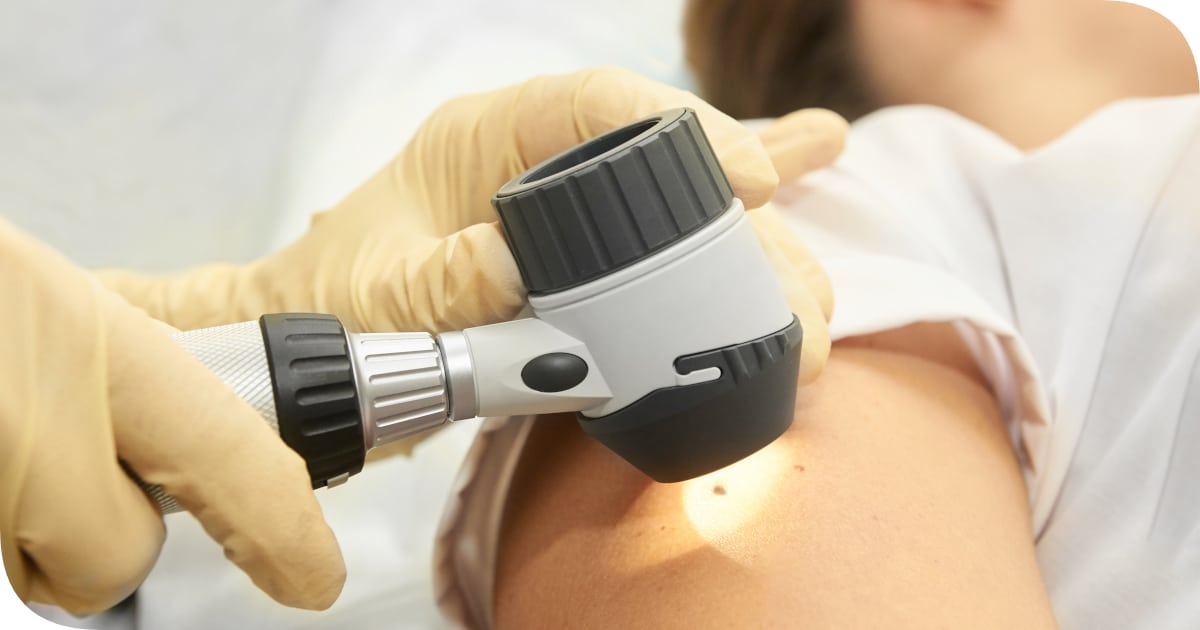 dermatoskopowe badanie znamion